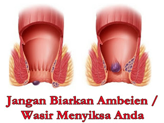 Illustration for article titled cara mengobati wasir cepat